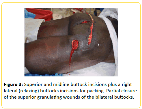 trauma-acute-care-midline-buttock