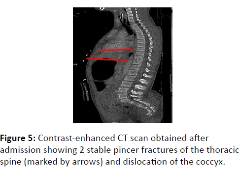 trauma-acute-care-pincer-fractures