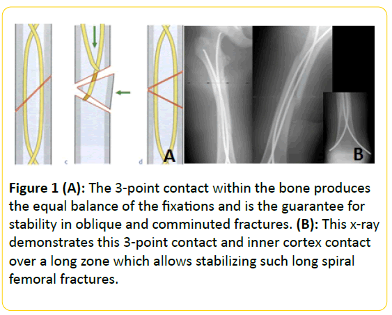 trauma-acute-care-point-contact-bone-produces