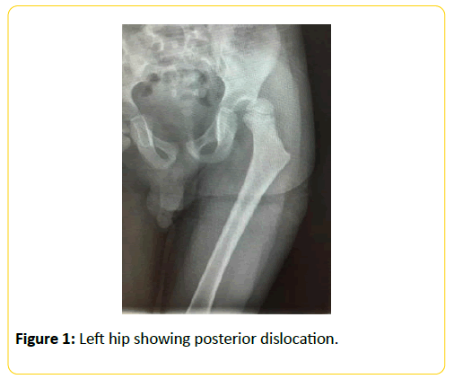 trauma-acute-care-posterior-dislocation