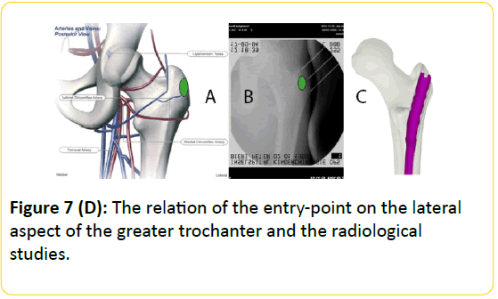 trauma-acute-care-relation-entry-point-lateral-aspect