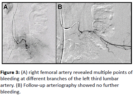 trauma-acute-care-right-femoral