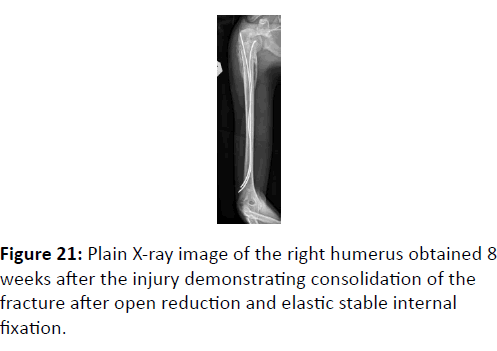 trauma-acute-care-right-humerus