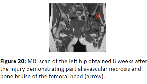 trauma-acute-care-scan-of-the-left-hip