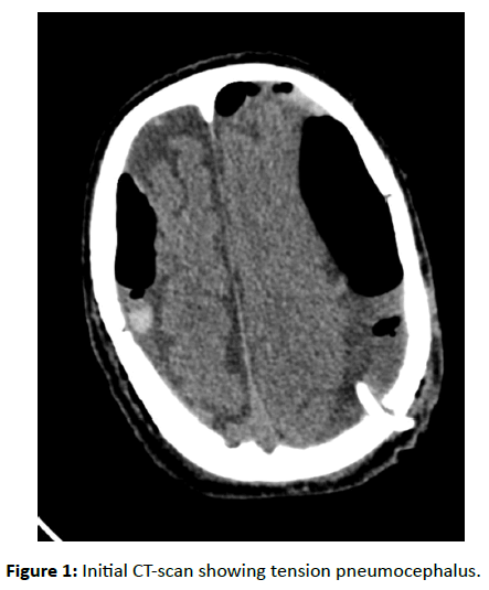 trauma-acute-care-tension-pneumocephalus