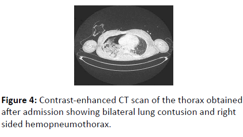 trauma-acute-care-thorax-obtained