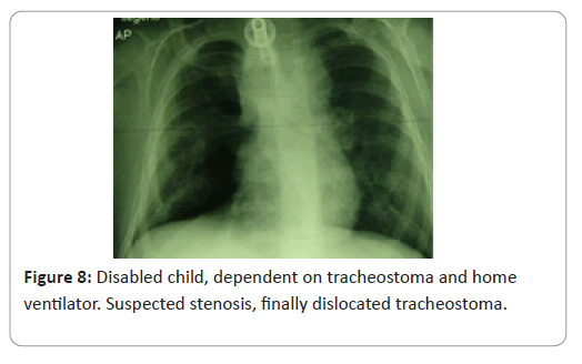 trauma-acute-care-tracheostoma