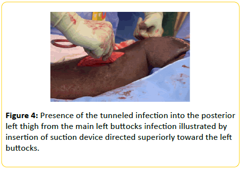 trauma-acute-care-tunneled-infection