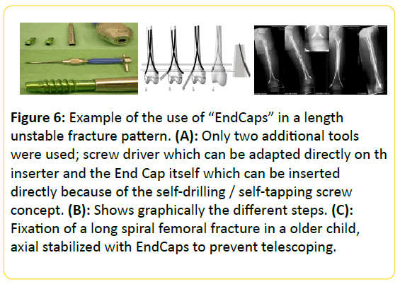 trauma-acute-care-unstable-fracture-pattern