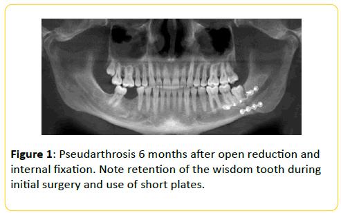 trauma-acute-care-wisdom-tooth